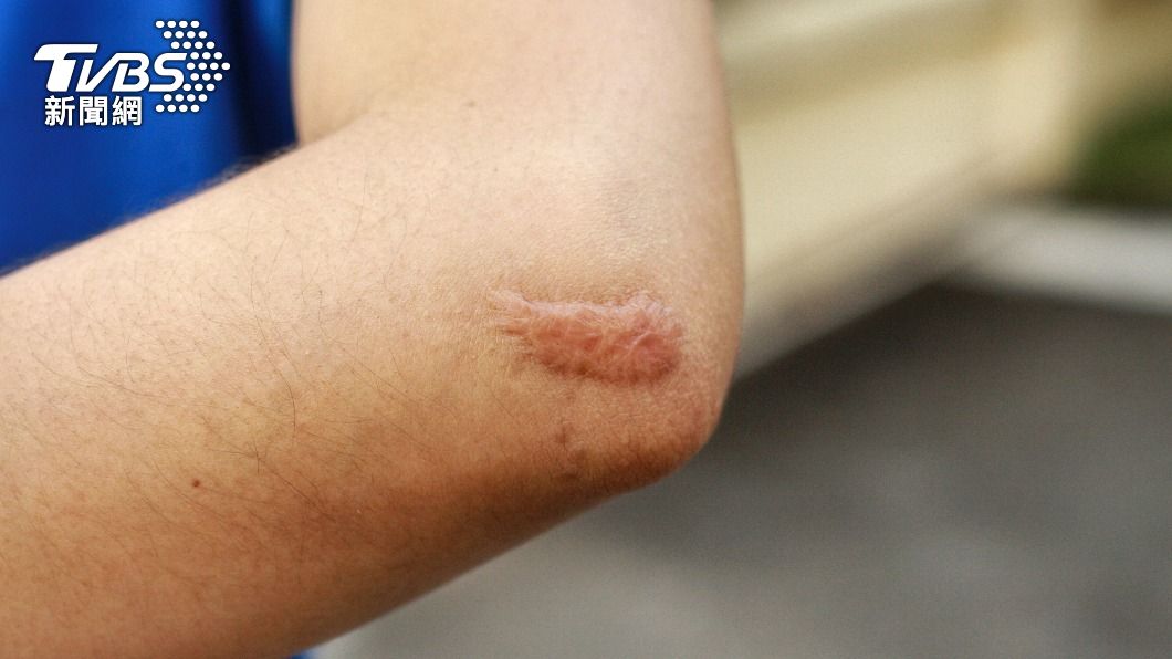 蟹足腫最常出現在上胸、後背、頭部、頸部與耳朵上。(示意圖/shutterstock達志影像)