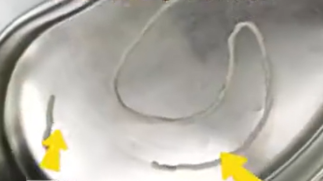 男子腫包竟是蟲窩。(圖/翻攝自微博)