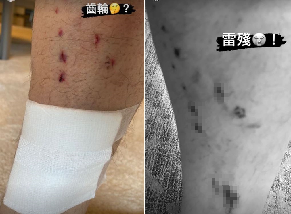 庾澄慶身上有多處傷口。（圖／翻攝自庾澄慶IG）