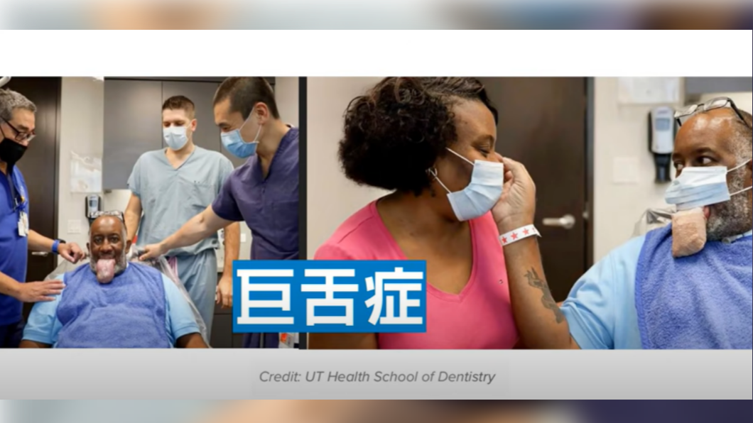 新冠舌頭包含巨舌症。(圖/翻攝自京硯聯合診所整形外科 / 皮膚科YouTube)