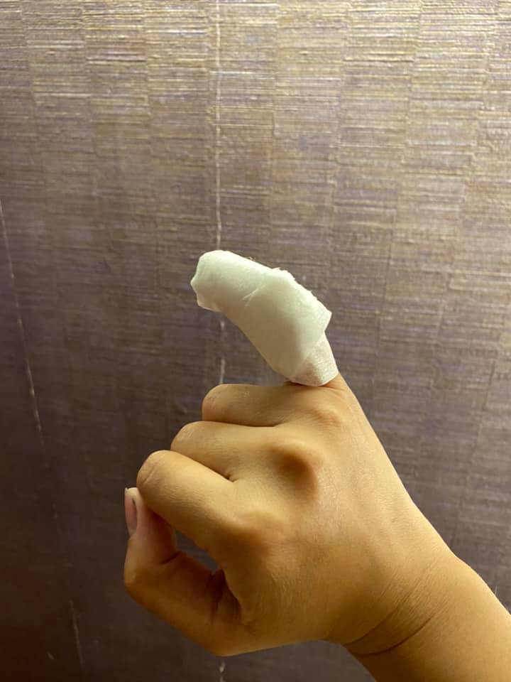 一名女遊客的右手小指遭15公分大的蜈蚣咬傷。(圖/翻攝自「好想住飯店⭕好康.踩雷不藏私」臉書社團)