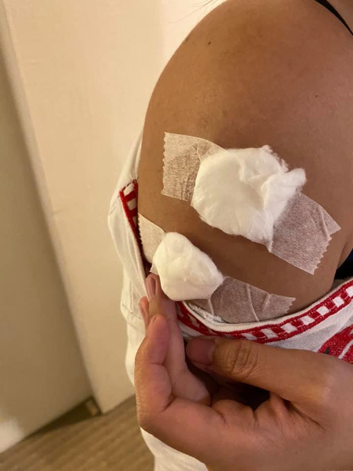 一名女遊客的手臂遭15公分大的蜈蚣咬傷。(圖/翻攝自「好想住飯店⭕好康.踩雷不藏私」臉書社團)