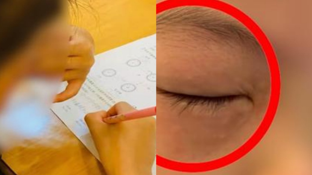 一算數學就過敏!陸9歲女童眼睛紅腫睜不開 怪病爆熱議