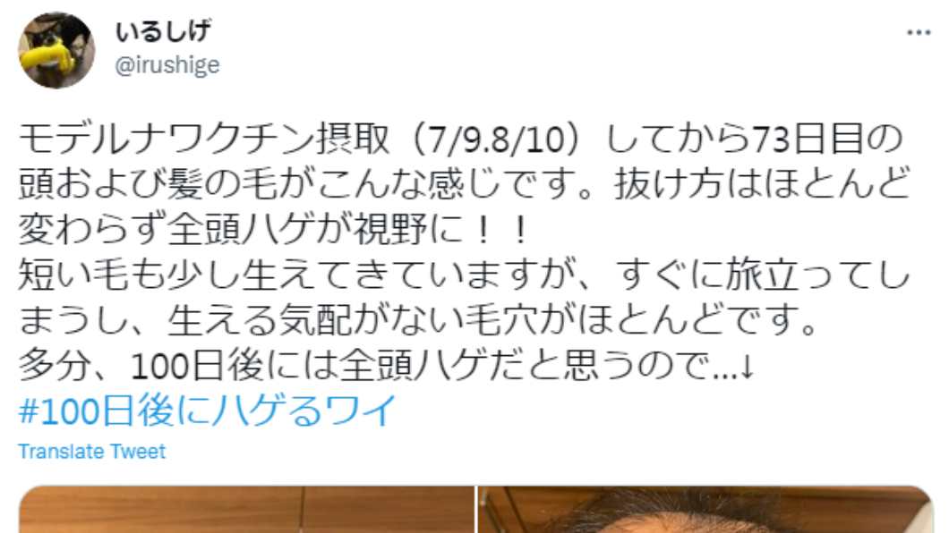 男子自嘲100天後應該會禿頭。(圖/翻攝自@irushige推特)