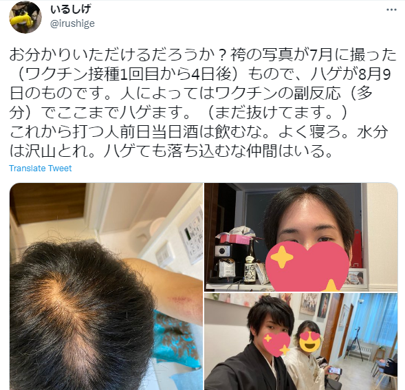 男子發文透露接種莫德納後開始掉髮。(圖/翻攝自@irushige推特)