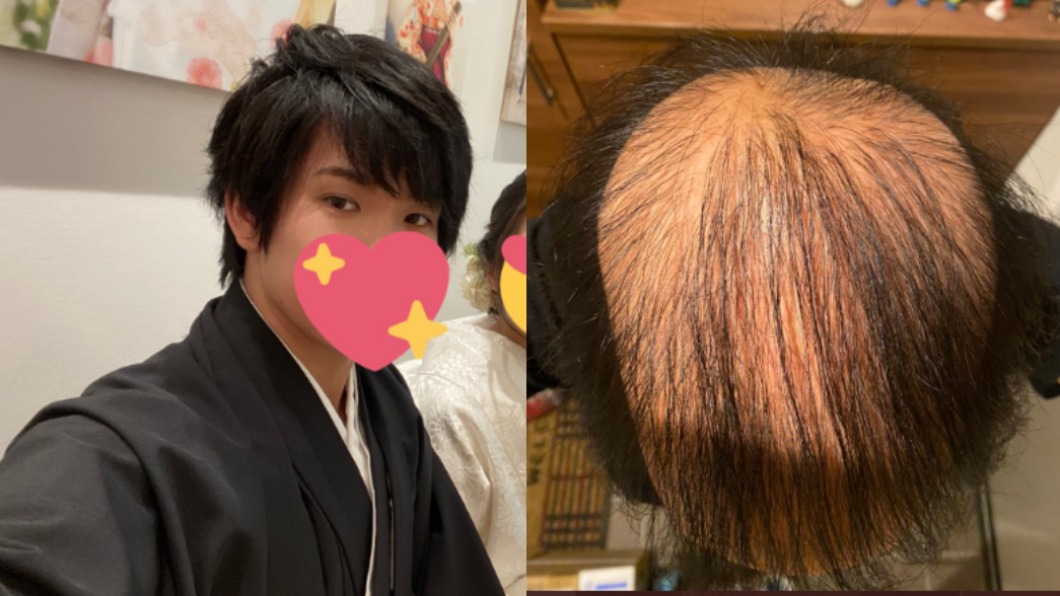 日帥哥打莫德納狂掉髮　「頭皮超清楚」自嘲：百天就全禿