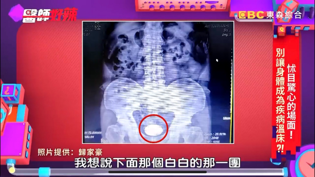 阿嬤下面白白一大團。(圖/翻攝自YouTube《醫師好辣》頻道)