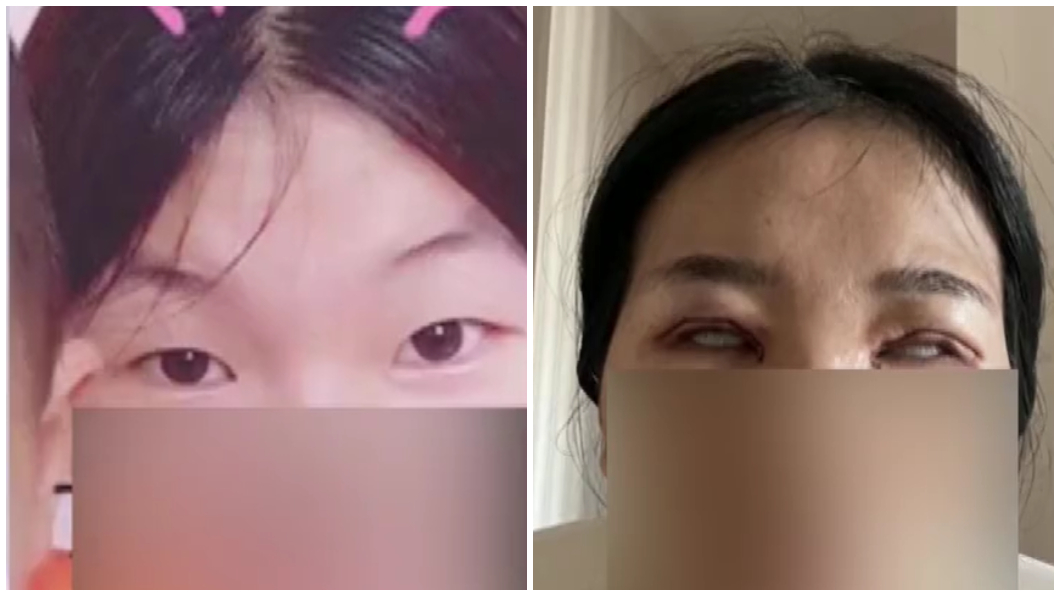 人妻愛美割雙眼皮 術後變「怪物」尪嚇到提離婚