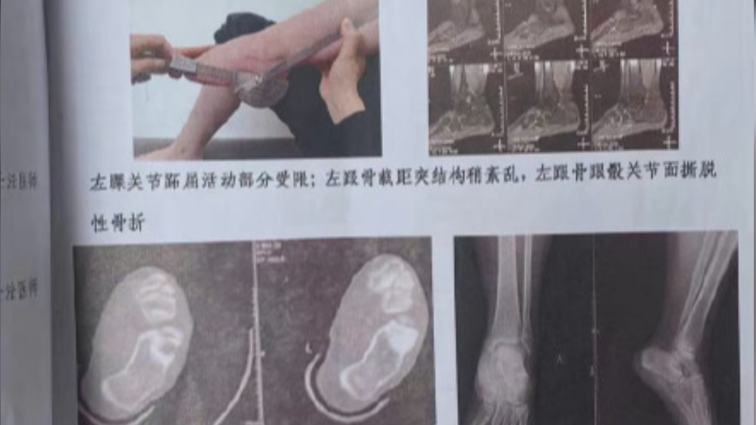 女學生腳部受到不可逆損傷。(圖/翻攝自微博)
