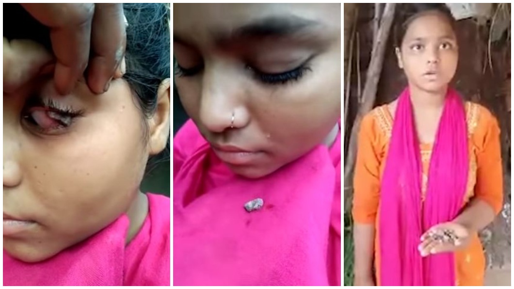 15歲少女眼紅腫「流眼淚掉石頭」　醫一看搖頭：沒法醫