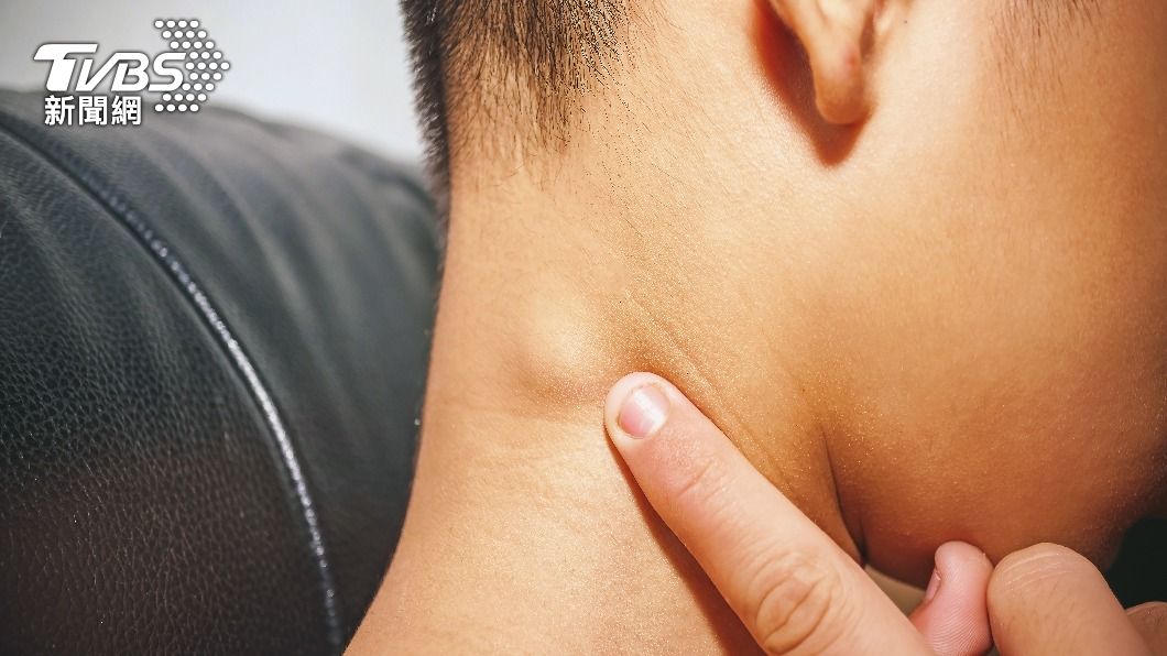 脖子腫塊大多是淋巴結腫大。(示意圖/shutterstock達志影像)