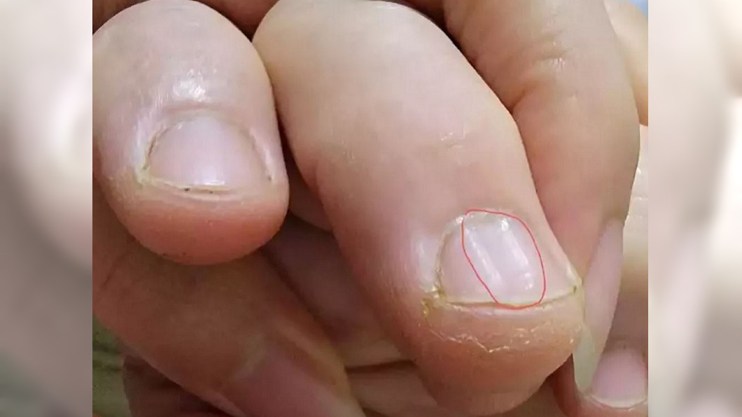 指甲驚現一道「垂直凹槽」!過來人警告:快就醫
