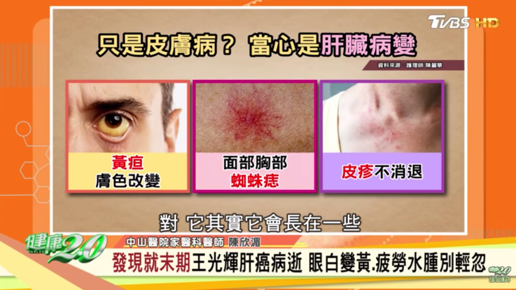 3大皮膚狀況,可能是肝臟病變。(圖/TVBS《健康2.0》)