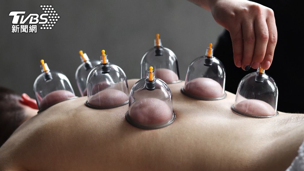 拔罐也能DIY?可排濕氣、改善循環 出現「這顏色」要注意