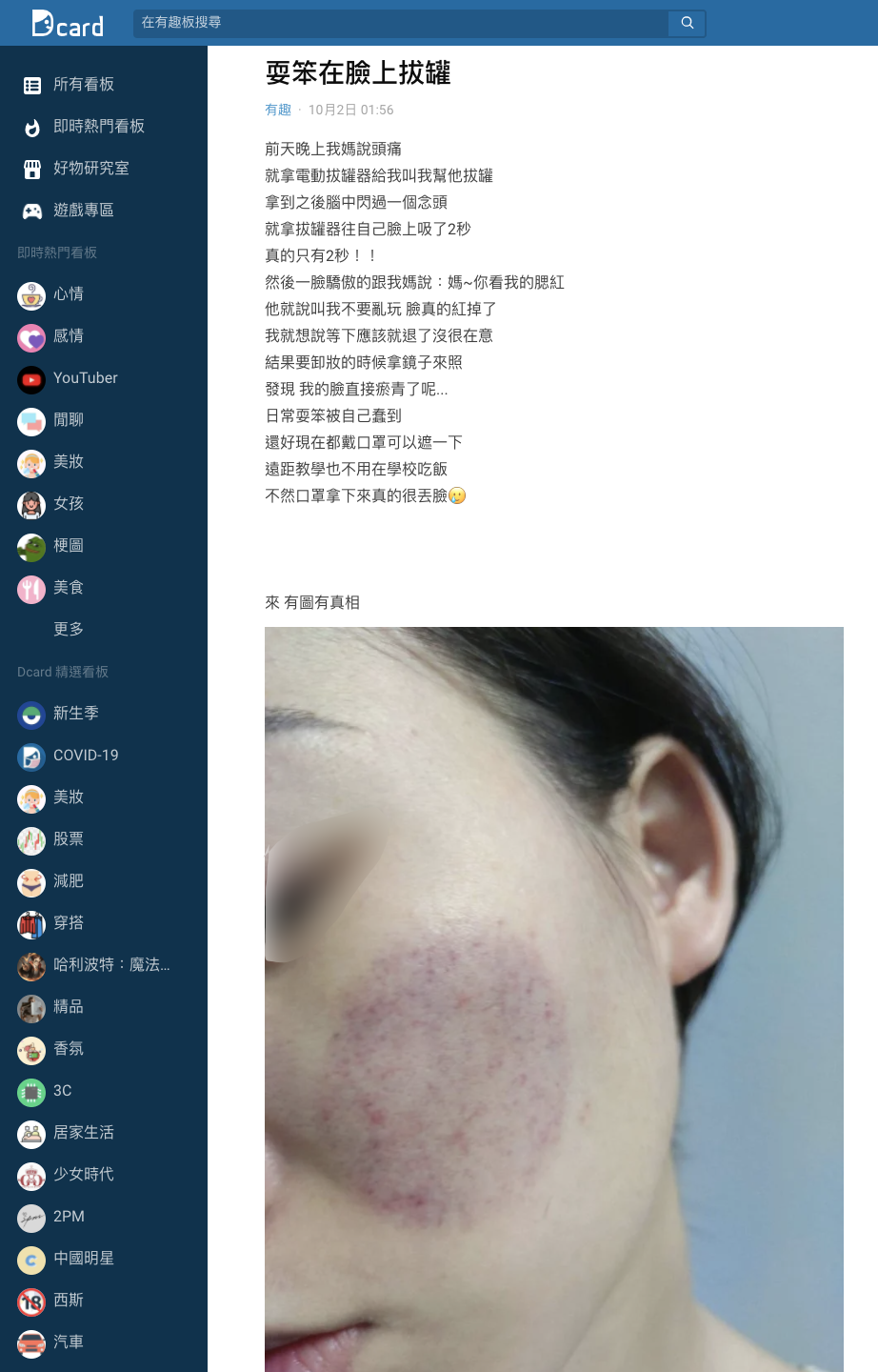 女大生往自己臉上拔罐結果造成瘀青。(圖/翻攝自Dcard)