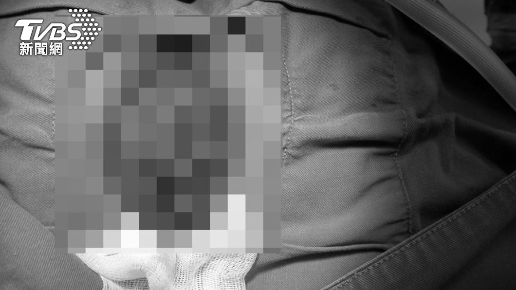 醫師形容男子的痔瘡有如「檸檬蛋糕」般露在外頭。（圖／蕭慕琦醫師授權提供）