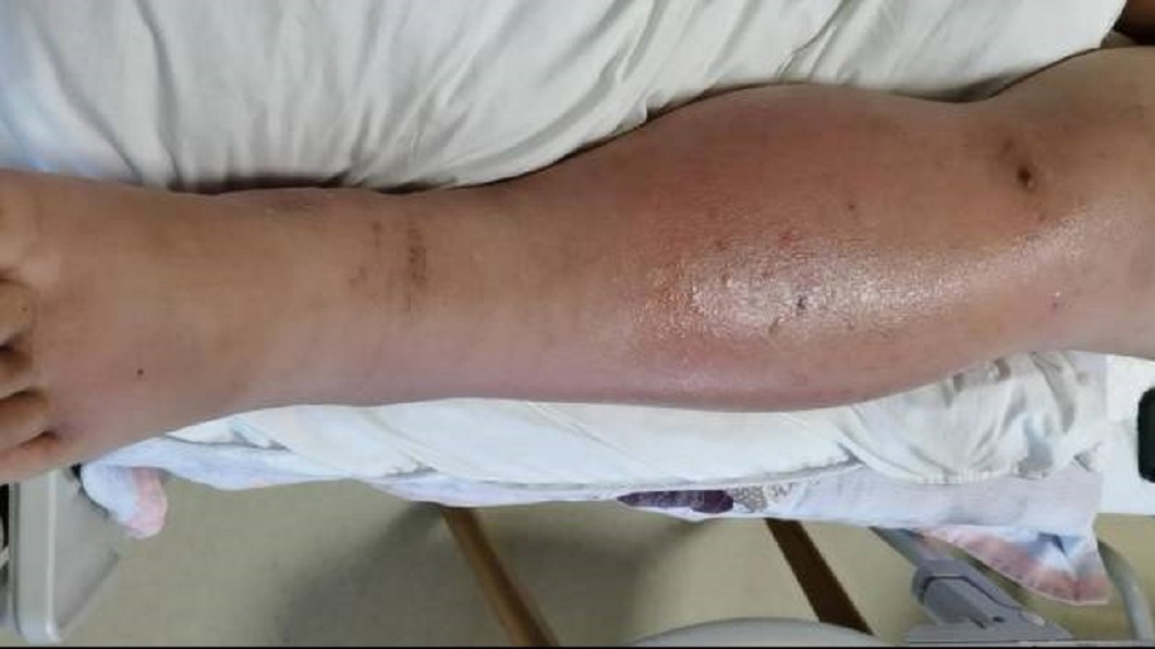38週孕婦被蚊子叮 「傷口潰爛變象腿」母嬰險不保