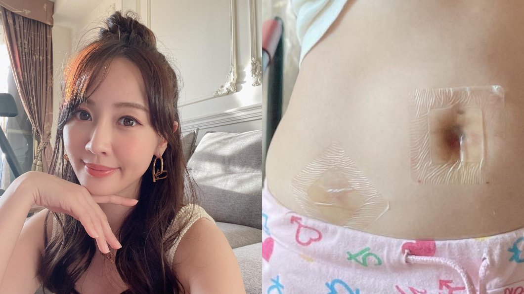 首次開刀「肚子被鑽3個洞」 女星憂留疤:像顆保齡球