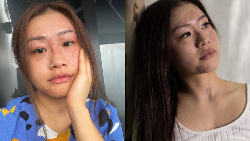 莎琳在炸甜甜圈過程中,不小心燒傷。(圖/翻攝自charlenechew IG)