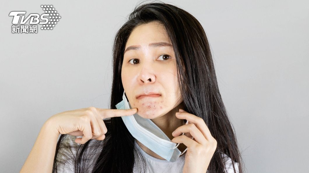 專家指出,長痘痘的原因有很多,包含過量分泌皮脂。(示意圖/shutterstock達志影像)