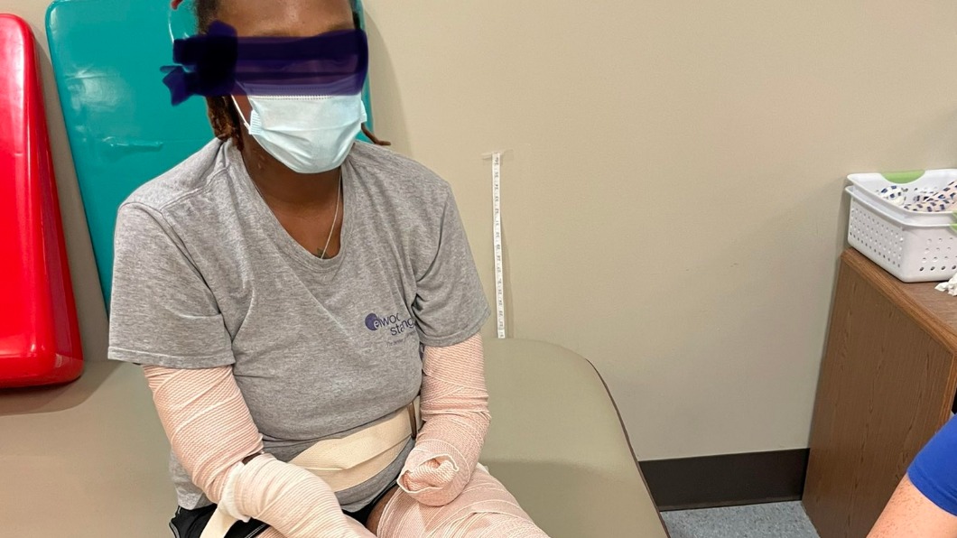 染新冠併發血栓!美女手腳慘遭截肢 勇敢曬照籲打疫苗