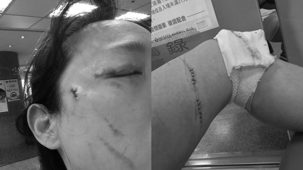 戳眼案翻版!提醒戴好口罩 女遭美工刀狂刺、徒手戳眼濺血