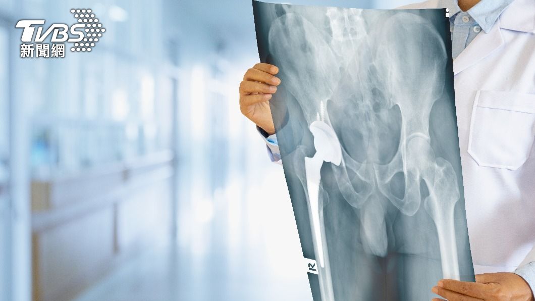 根據研究,造成股骨頭缺血性壞死的原因,在台灣有超過4成是因為飲酒。(圖/shutterstock達志影像)