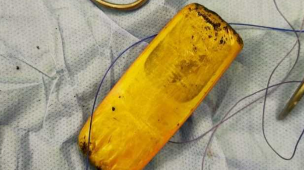 扯！埃及男腹疼入院　醫照X光驚見「手機」卡肚中半年