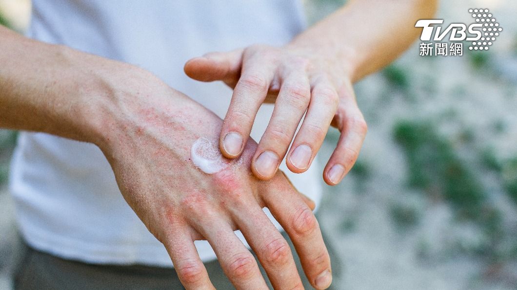 外用藥膏開封後3-6個月就應該丟棄。（示意圖／shutterstock達志影像）