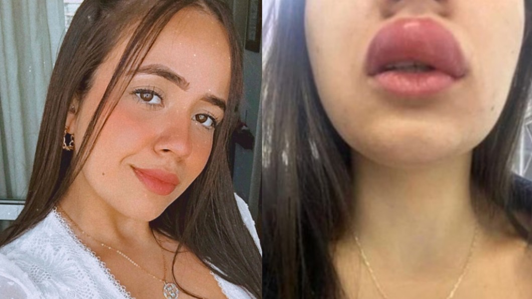 巴西女熟睡痛醒!驚見「蜈蚣」咬嘴唇 下秒慘變香腸嘴