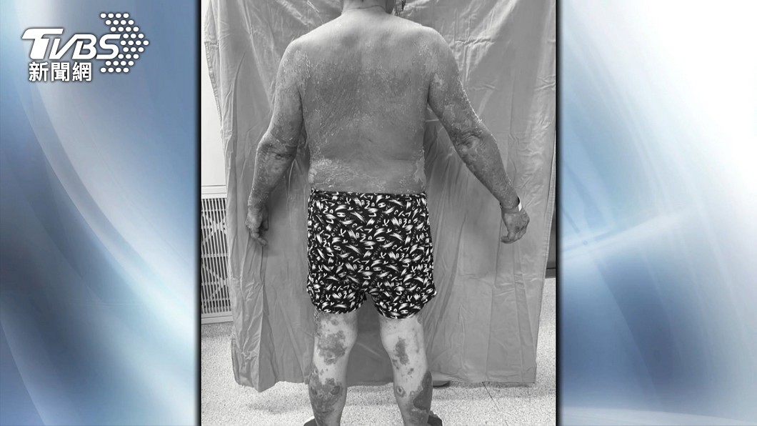 澎湖男打莫德納「全身膿皰大面積脫皮」 莊人祥曝病況