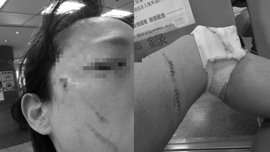 王女身上多處受傷,送醫縫了好幾針。(圖/翻攝自爆料公社公開版)