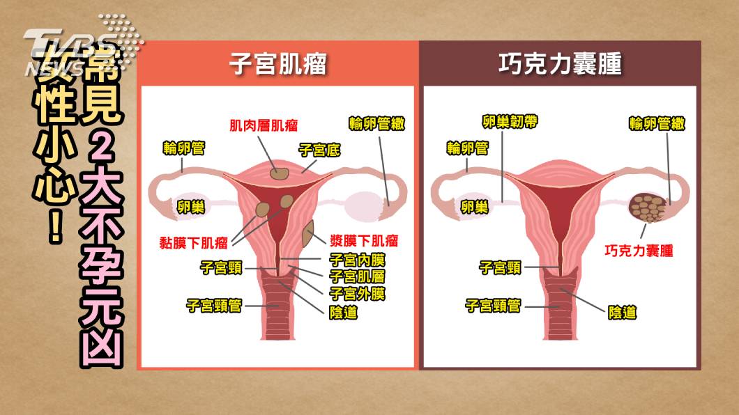 門診最常見的兩大不孕元凶為「巧克力囊腫」及「子宮肌瘤」。(圖/TVBS提供)