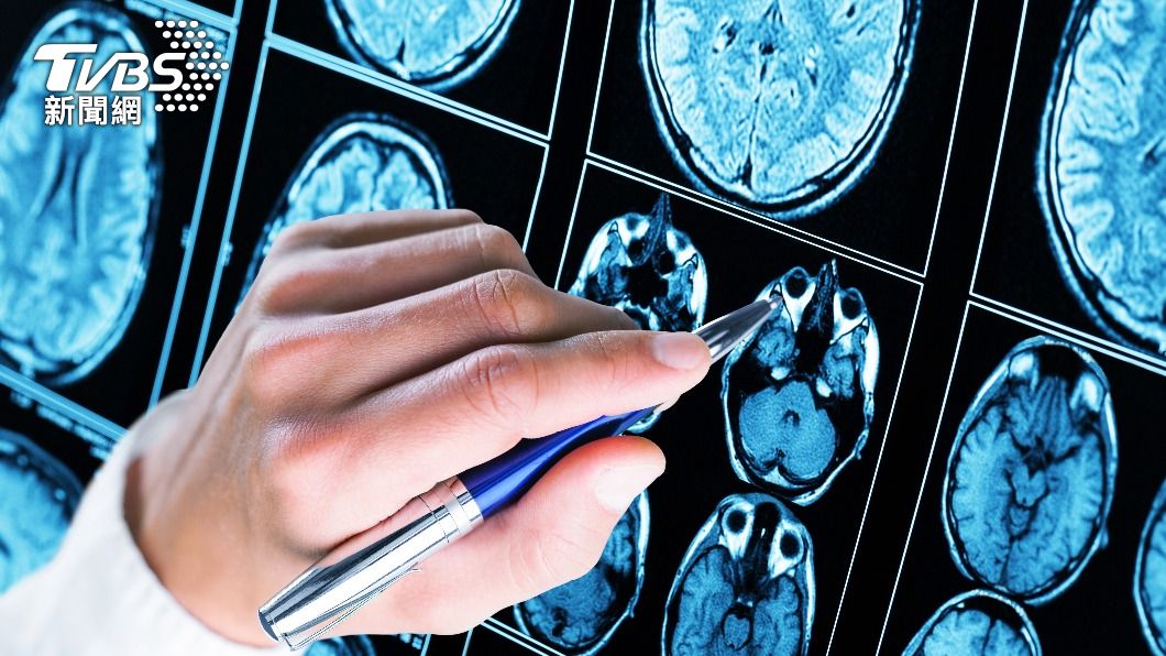 癲癇是因為體質或腦部疾病，造成腦細胞不正常放電。（圖／shutterstock達志影像）