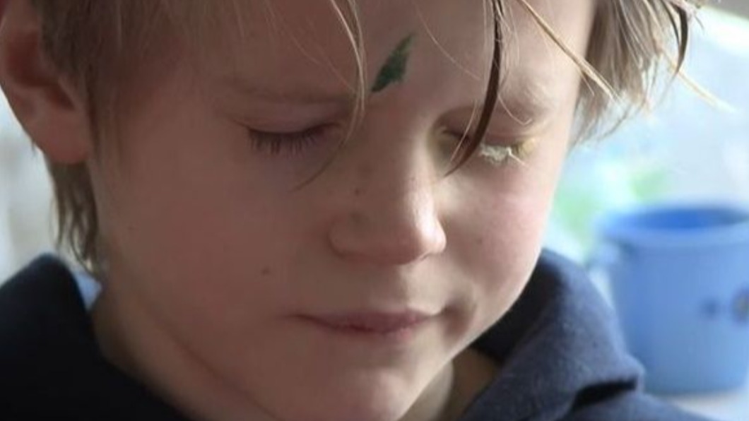 英粗心父強力膠當眼藥膏！害9歲兒眼皮黏住　4天睜不開