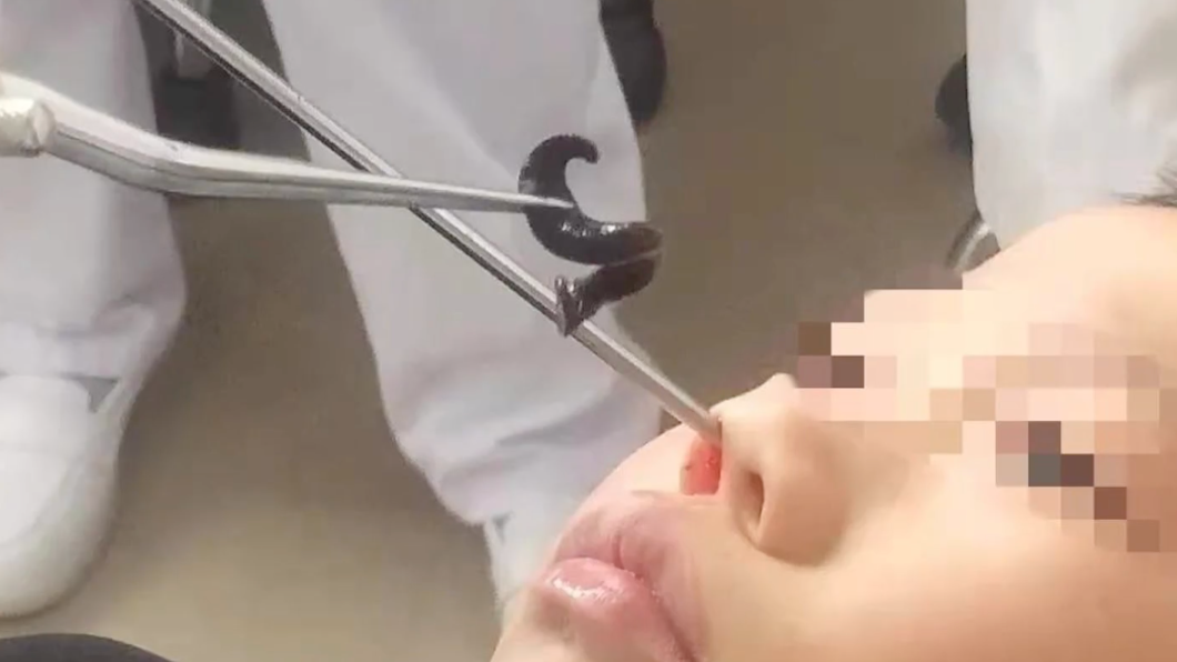 男童鼻腔夾出一隻螞蟥。(圖/翻攝自微博)