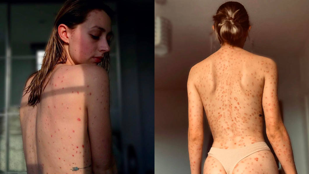 克萊兒的紅斑時明顯時不明顯。（圖／翻攝自Instagram@claires__psoriasis）