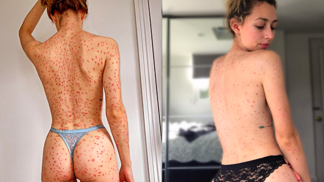 克萊兒大方秀出自己的紅斑。（圖／翻攝自Instagram@claires__psoriasis）