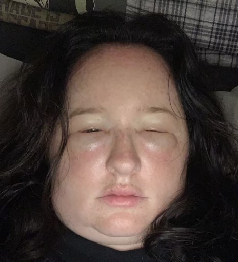 凱莉因為染髮劑引起的過敏反應，臉腫成豬頭她的丈夫都被嚇到。（圖／翻攝自《Daily Mail》）