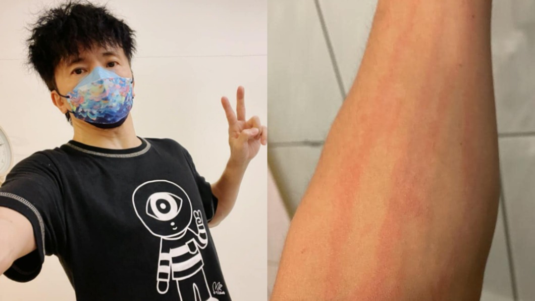 唐從聖打完AZ「全身奇癢」 醫曝止癢「這樣做」最有效