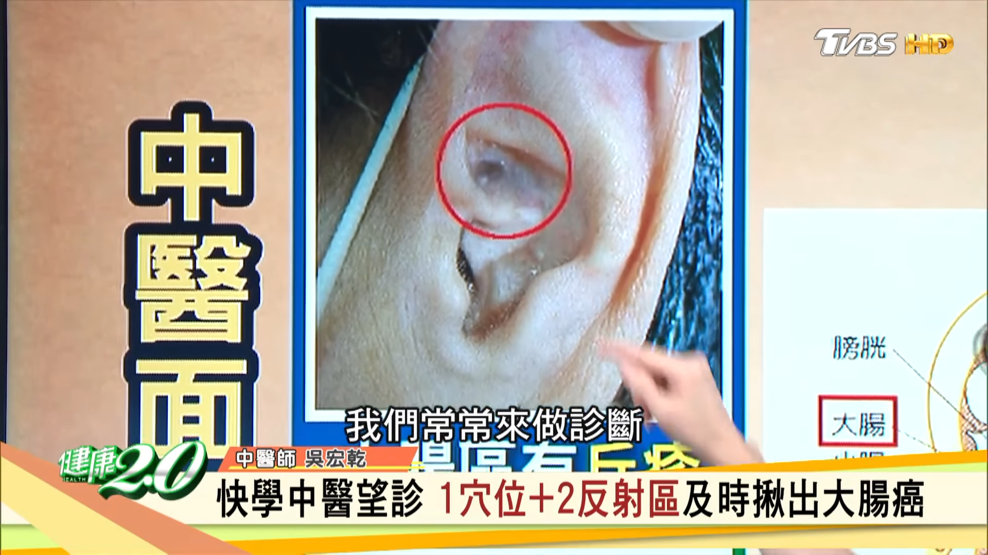 耳朵「大腸區」出現丘疹,顏色呈現焦黑。(圖/TVBS)