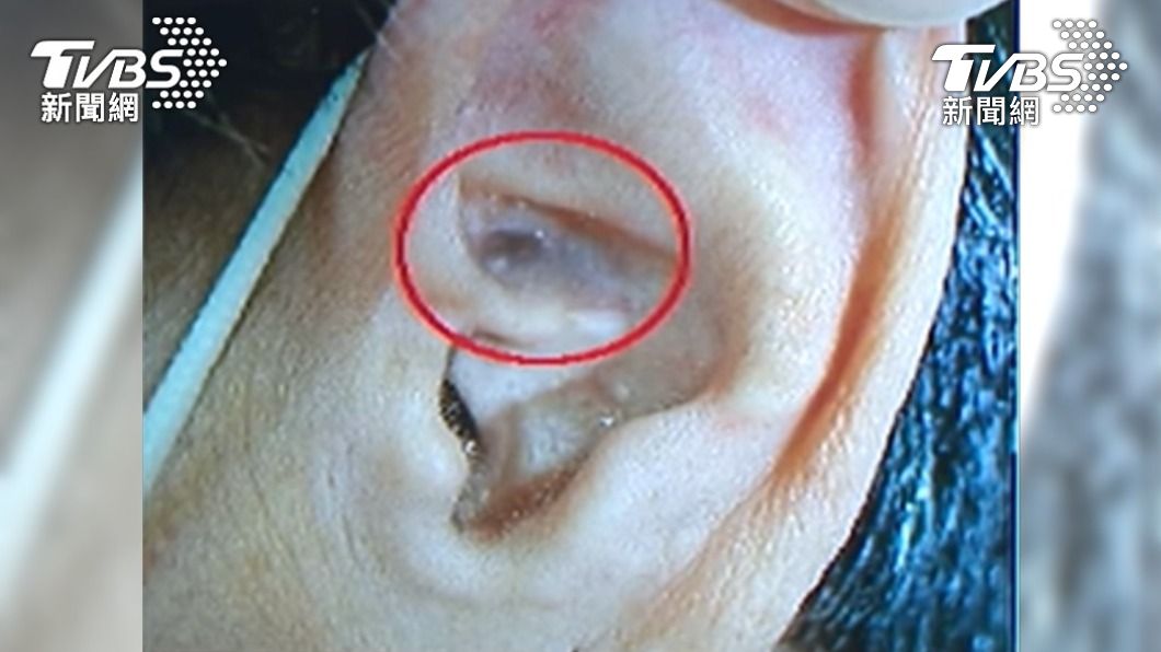 每年5千人大腸癌亡!耳朵、臉有「這症狀」醫警告快就醫