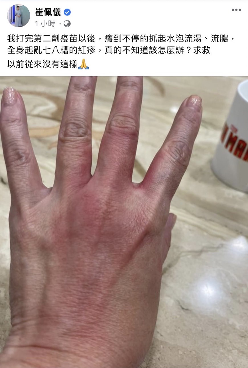 崔佩儀全身奇癢無比。(圖/翻攝自崔佩儀Facebook)