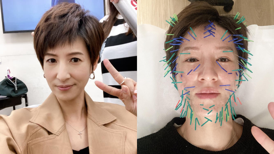 百根針刺臉!主播夏嘉璐成針包 醫揭這美容法視覺減5歲