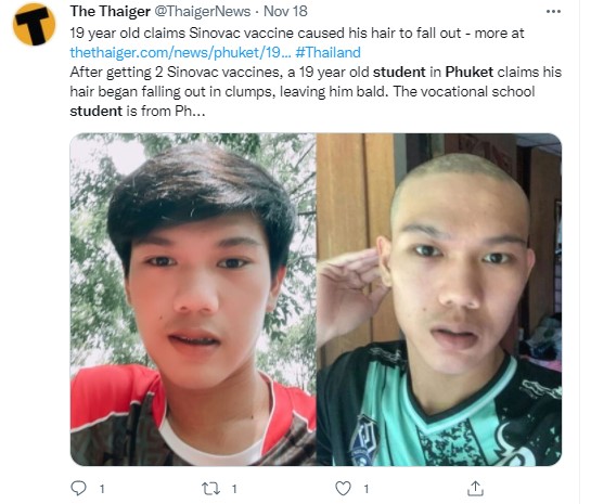 巴汀原先擁有茂密黑髮，不料接種疫苗後卻嚴重落髮近乎全禿。（圖／翻攝自推特＠ThaigerNews）
