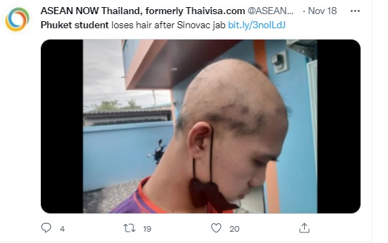 泰國19歲男子接種完2劑科興疫苗後大量落髮。（圖／翻攝自推特＠ASEANNOWTH）