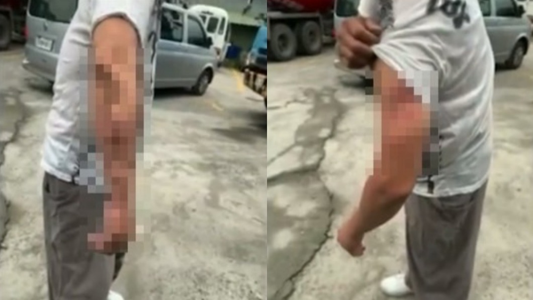 張姓被害人被打到手骨折。(圖/Facebook●【爆料公社二社】●)