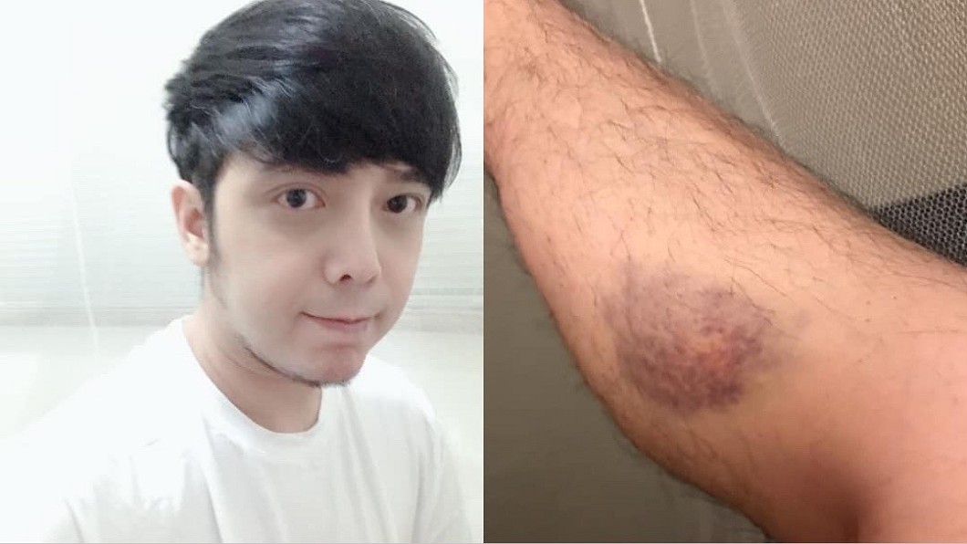 後腦勺撞地送醫!小炳「驚罹菌血症」命危:扛不住恐死