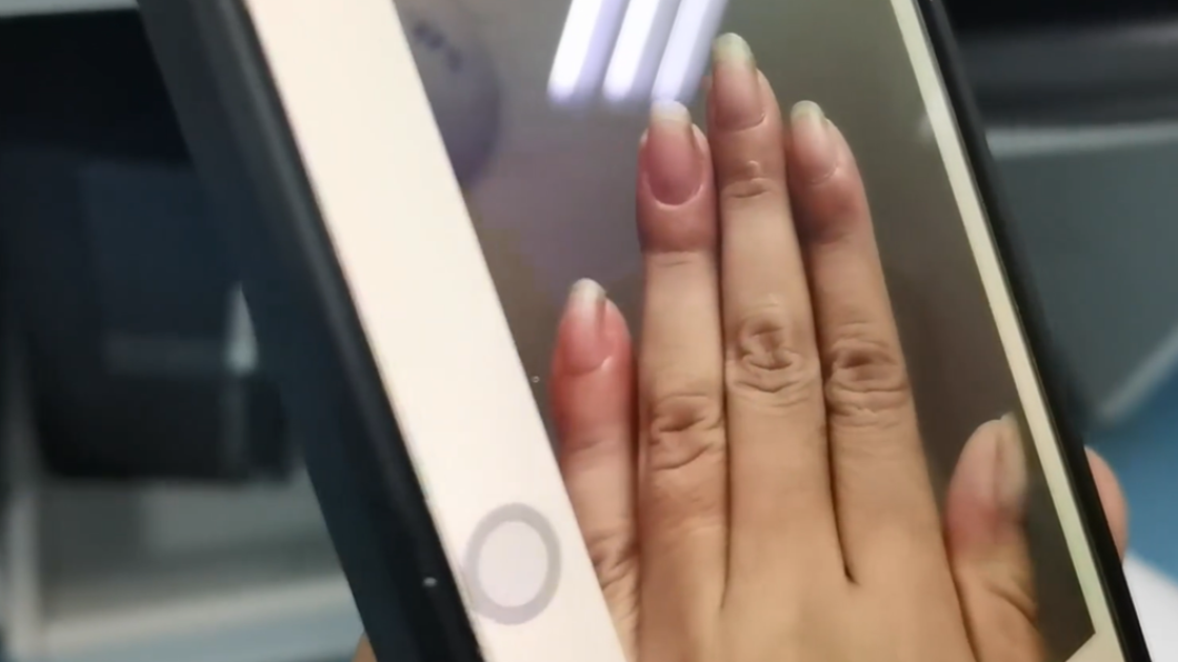 陸女手指腫成「蘿蔔」!拖半年不看病 檢查竟是肺癌