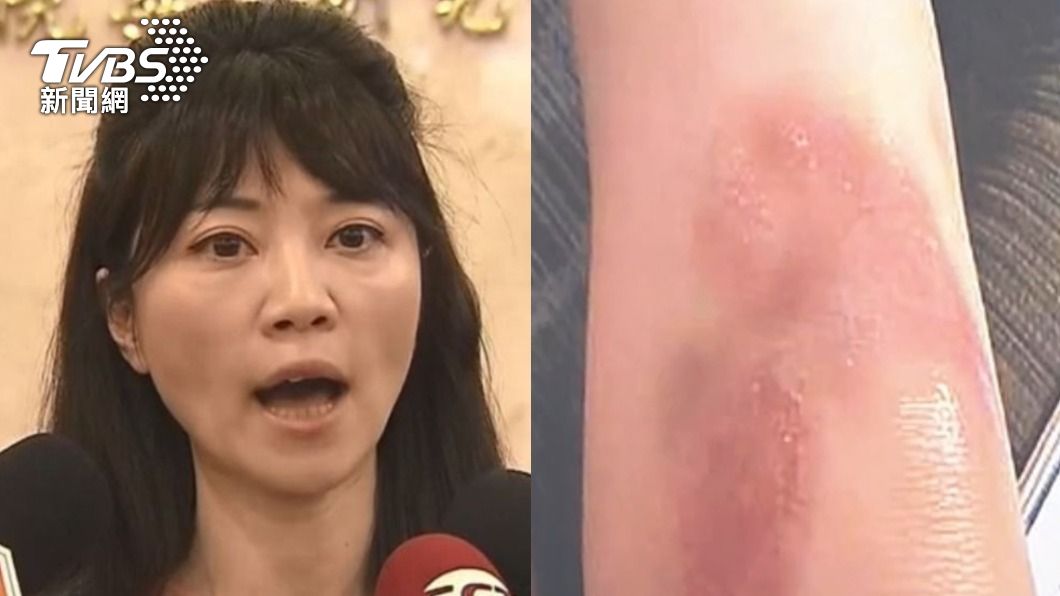 高嘉瑜遭毆當天急退通告! 自稱跌倒「嚇人傷勢照」曝光